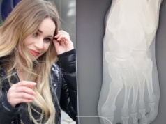 Ewelina Lisowska nabawiła się poważnej kontuzji. "Motocykl przejechał mi po nodze"