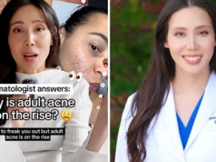 Coraz więcej dorosłych zmaga się z trądzikiem. Dermatolożka podpowiada, jak z nim walczyć