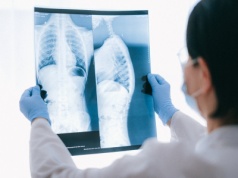 Sztuczna inteligencja w diagnostyce gruźlicy: przełomowe technologie zaprezentowane w Kopenhadze