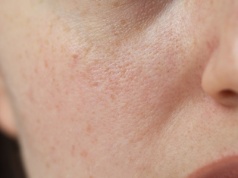 Ochłodzenie na horyzoncie. Jak przygotować naszą skórę?