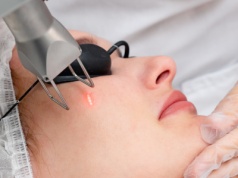 Na celowniku lasera. Odmłodzenie i leczenie