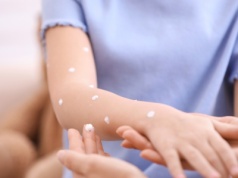 Odkryli nowy wariant małpiej ospy. Może zmienić przebieg choroby