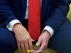 Siniaki na dłoniach Donalda Trumpa. Rzeczniczka Białego Domu podała zaskakujący powód