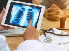 Rak płuca. Nowy program wczesnego wykrywania choroby na NFZ