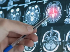 Sztuczna inteligencja pozwoli wcześniej wykryć tętniaki mózgu. „Ratowanie zdrowia i życia”