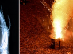 Koszmar. Petarda wybuchła w dłoni dziecka. Konieczna była amputacja