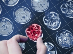 Rewolucyjny test na Alzheimera! Prosto z palca i bez wychodzenia z domu?