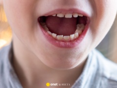 Nowa metoda na wadę zgryzu u dzieci. Rodzice zachwyceni, eksperci alarmują