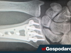 Sezon złamań trwa w najlepsze