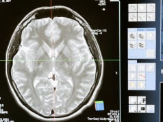 Bezpłatne badania wykrywające nowotwory głowy i szyi w Poznaniu. Kto może skorzystać?