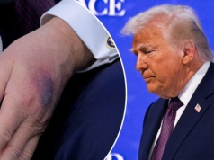 Niepokojący wygląd dłoni Trumpa. Biały Dom reaguje, jest oświadczenie