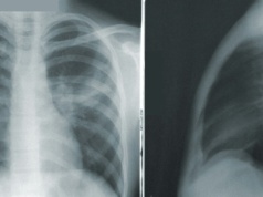 Cyberpunk dzieje się już dziś. Sztuczne płuca uratowały mu życie