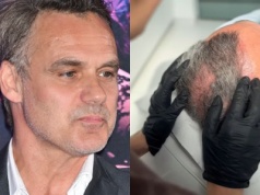 Jan Wieczorkowski przeszedł przeszczep włosów. Tak wygląda po prawie roku