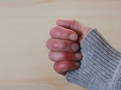 Zima atakuje skórę. Czas na odmrożenia, ale i oparzenia