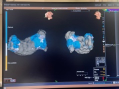 Nowa era leczenia arytmii w Bielsku-Białej: pierwsze zabiegi systemem Volt