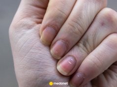 Dlaczego mam białe kreski na paznokciach? Stąd się biorą