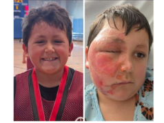 Niebezpieczny trend z TikToka. 9-latek ciężko poparzony po włożeniu zabawki do mikrofalówki