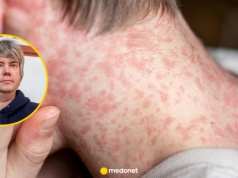 "Zapomniana choroba" wraca? Ekspert: to jeden z najbardziej zaraźliwych wirusów, jakie znamy