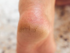 Zapomniana perełka z apteki. Stopy będą gładziutkie. Zapłacisz 15 zł