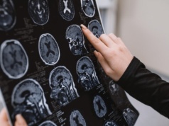 Guz mózgu po leku antykoncepcyjnym dostępnym w UK, Irlandii i Polsce