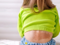 Przełom w leczeniu dokuczliwej choroby u dzieci. Pierwsze takie zabiegi wykonano w Polsce