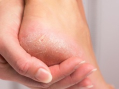 Kup w aptece i nałóż na pięty. Będą gładkie i nawilżone