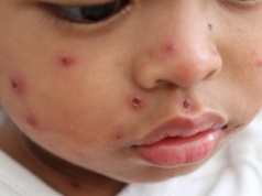 Zapomniana choroba uderza w Londyn. Ostrzeżenie dla całej Europy