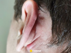 Masz ten znak na uchu? Może ostrzegać przed zawałem serca