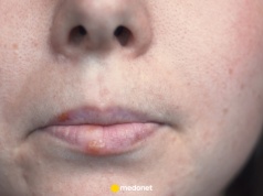 Niedoczynność tarczycy widać po twarzy. Oto jak wygląda "twarz tarczycowa"