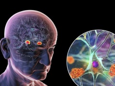 Znaleźli czynnik sprzyjający chorobie Alzheimera. Jest wokół nas