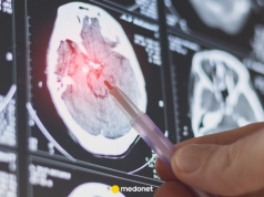 Nowy sposób walki z chorobą Alzheimera. Pacjent będzie leczony w trakcie snu