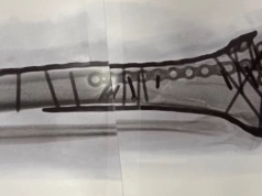 Lindsey Vonn przeszła koszmar. Odkryła szokującą rzeczywistość po wypadku