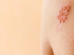 Prof. Paradowska-Stankiewicz: Przeciwko półpaścowi można się szczepić przez cały rok