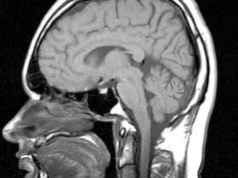 Depresja kosztuje światową gospodarkę bilion dolarów rocznie