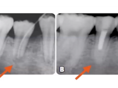 Niebezpieczeństwa związane z leczeniem kanałowym i sposoby ich leczenia