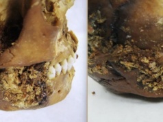 Znaleźli "prymitywną protezę" sprzed 2,5 tys. lat. Skomplikowana operacja