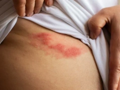 Fakty i mity na temat półpaśca. O tym trzeba wiedzieć