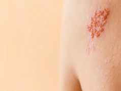 Półpasiec grozi milionom Polaków. Eksperci mówią jasno, kto powinien się zaszczepić