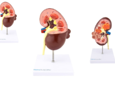 Kłębuszkowe zapalenie nerek – przyczyny, objawy i leczenie