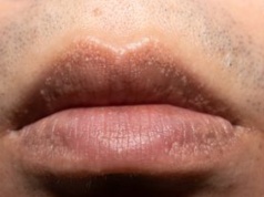 Białe plamki na wargach? Nie zawsze to tylko problem kosmetyczny