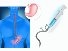 Sondy (zgłębniki) żołądkowe