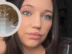 Chciała usunąć implant antykoncepcyjny. Lekarze ze strachem odkryli, gdzie się przemieścił