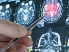 Pierwsza taka operacja glejaka w Polsce. Lekarze z Łodzi dokonali przełomu