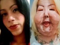 Chciała poprawić urodę. Dziś walczy o odzyskanie dawnej twarzy