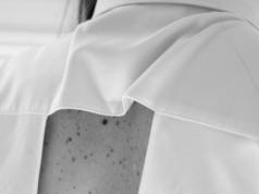 Łupież pstry - czy jest zaraźliwy?