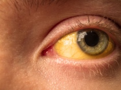 Żółte oczy, jakie mogą być przyczyny? Czego objawem są żółte białka oczu?  