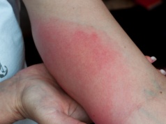 Coraz więcej zakażonych. To już nie jest problem sezonowy