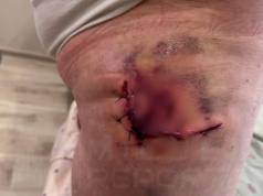 Agresywny dzik zaatakował 78-latkę! Kobieta została poważnie ranna