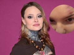 Monika Miller pokazała swoje RANY w sieci. "I jak się wytłumaczyć w pracy?"