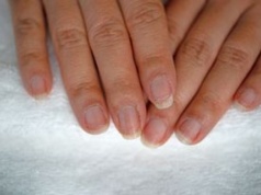 Masz czarną kreskę na paznokciu? Nie lekceważ. To ważny sygnał